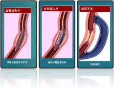 怎样治疗冠心。