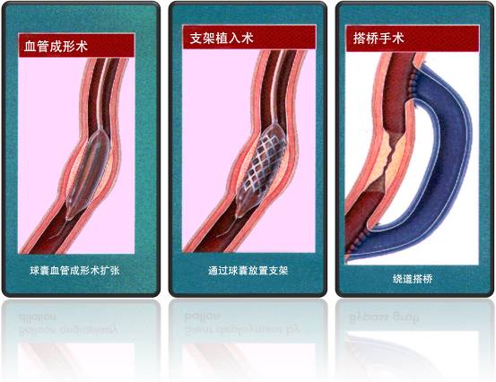 怎样治疗冠心。(图1)