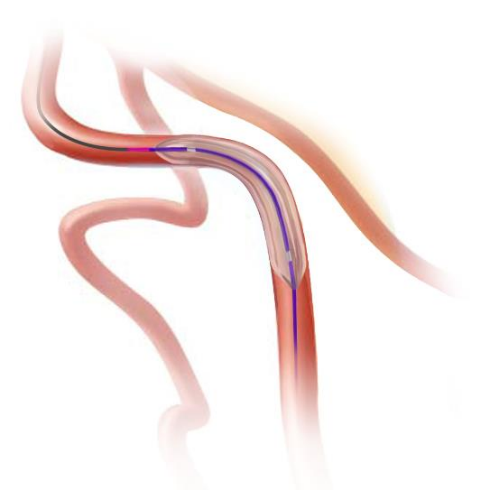 抱鱼?颅球囊扩张导管(图2)