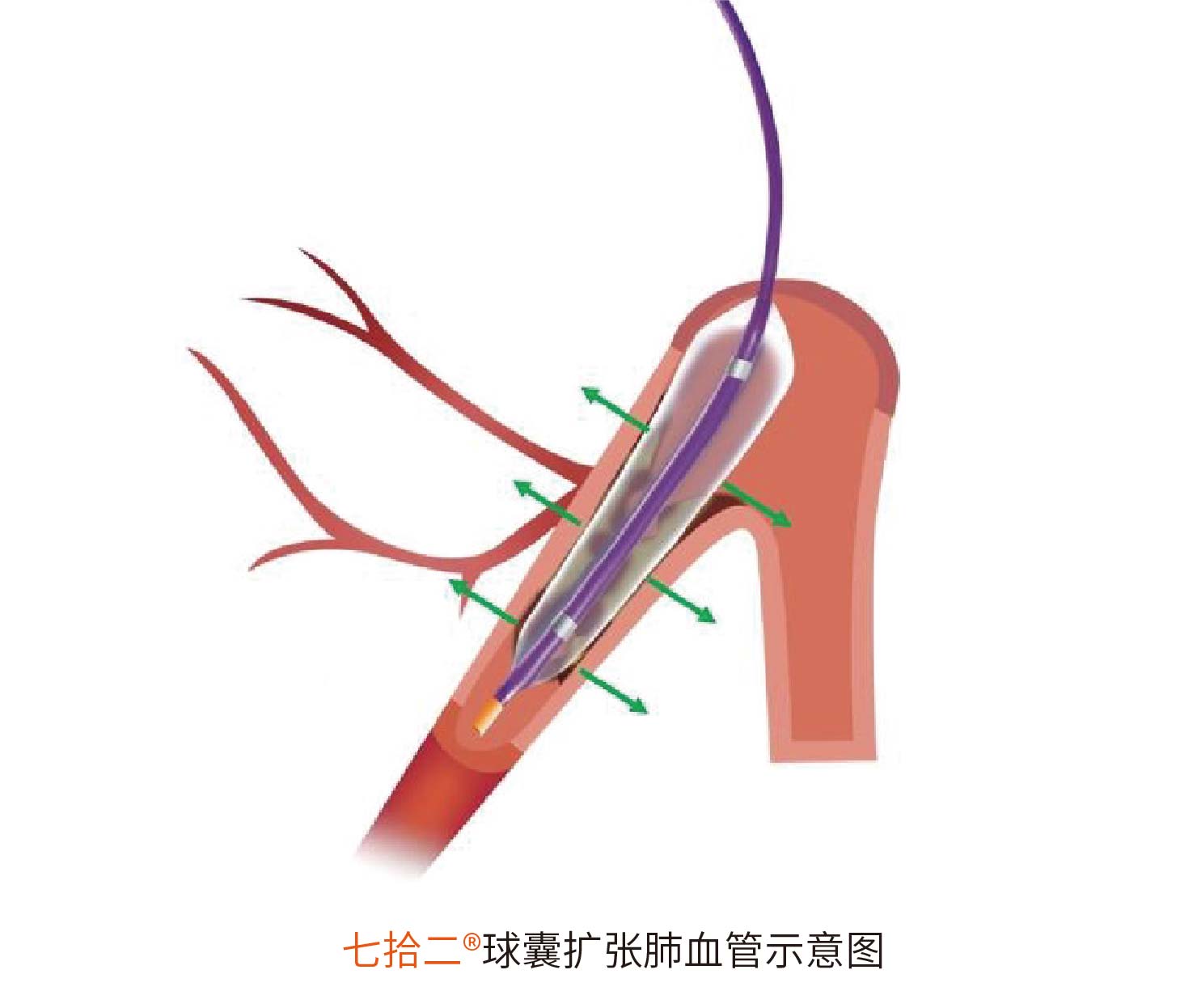 七拾二?Sev-changes 肺动脉球囊扩张导管(图2)